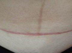 深圳剖腹產疤痕如何修復