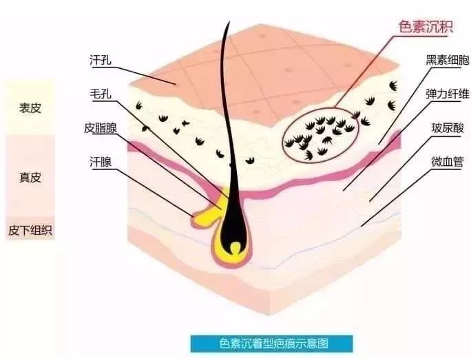 色素疤痕
