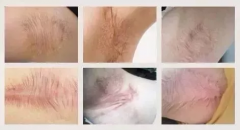 夏天到啦！還在為腋下疤痕煩惱嗎?！醫生教你這
