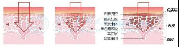 顏色不斷加深的色素沉着疤痕,原來是這樣形成的!